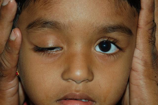 srijaneyehospital_Ptosis Surgery