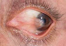 srijaneyehospital_Pterygium surgery