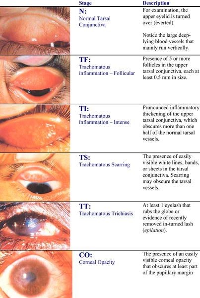 srijaneyehospital_Vision_Rehabillation_11